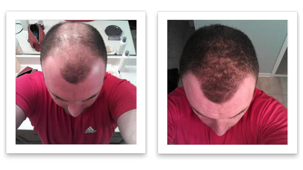 Prima e dopo l'uso di Caboki 30 g — foto del risultato del cliente stesso