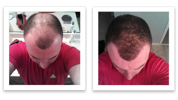 Prima e dopo l'uso di Caboki 30 g — foto del risultato del cliente stesso