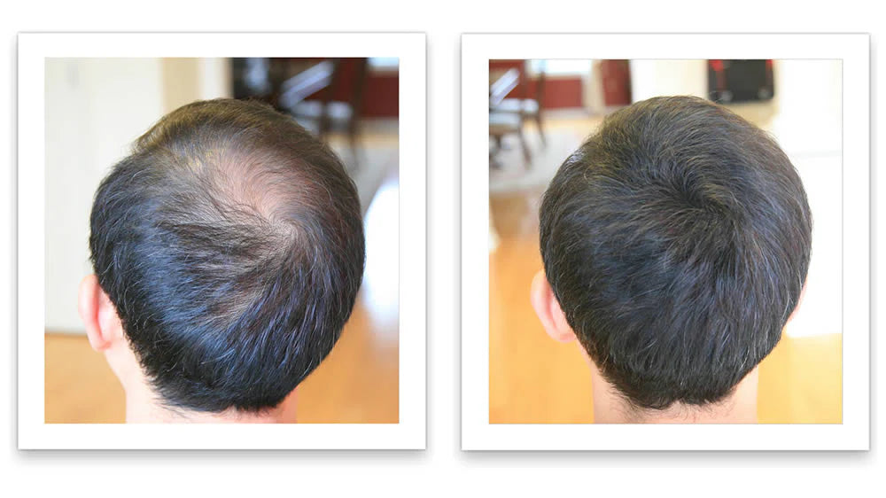 Prima e dopo l'uso di Caboki 30 g — foto del risultato del cliente stesso