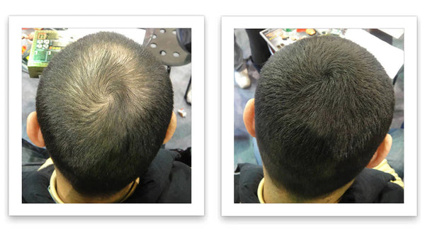 Prima e dopo l'uso di Caboki 30 g — foto del risultato del cliente stesso