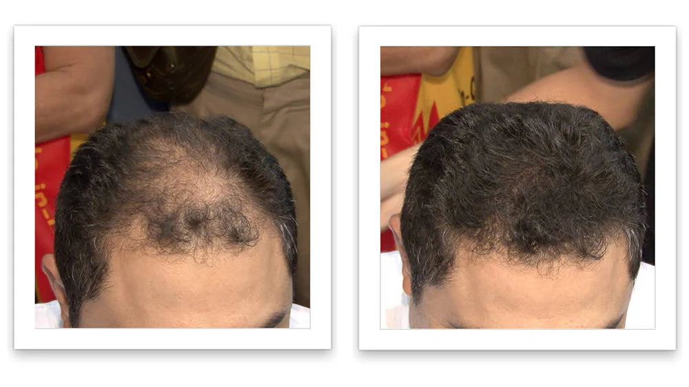 Prima e dopo l'uso di Caboki 30 g — foto del risultato del cliente stesso