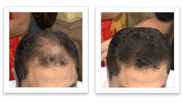 Prima e dopo l'uso di Caboki 30 g — foto del risultato del cliente stesso