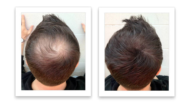 Prima e dopo l'uso di Caboki 30 g — foto del risultato del cliente stesso