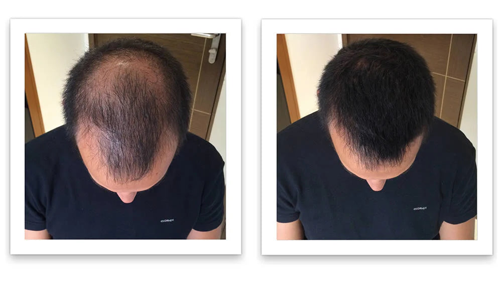 Prima e dopo l'uso di Caboki 30 g — foto del risultato del cliente stesso