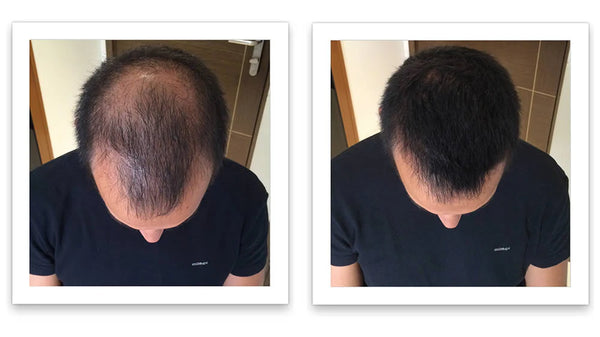 Prima e dopo l'uso di Caboki 30 g — foto del risultato del cliente stesso