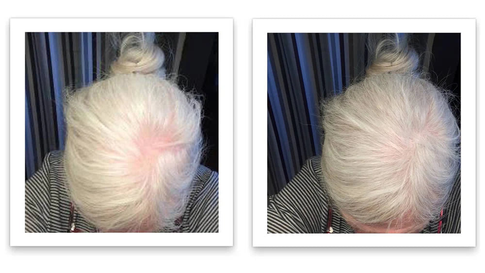 Prima e dopo l'uso di Caboki 30 g — foto del risultato del cliente stesso
