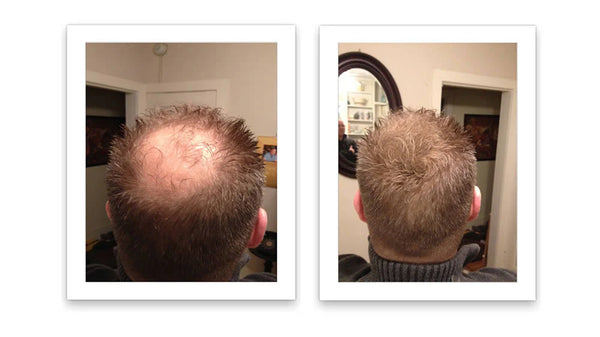 Prima e dopo l'uso di Caboki 30 g — foto del risultato del cliente stesso