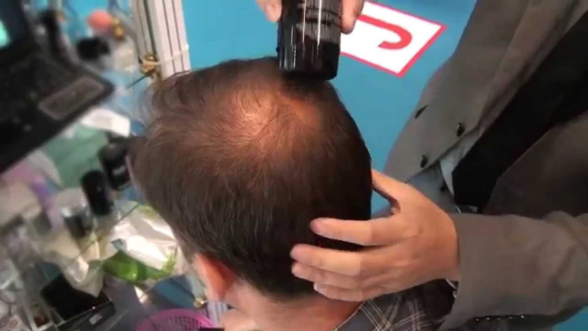 Hair Thinning on the Crown